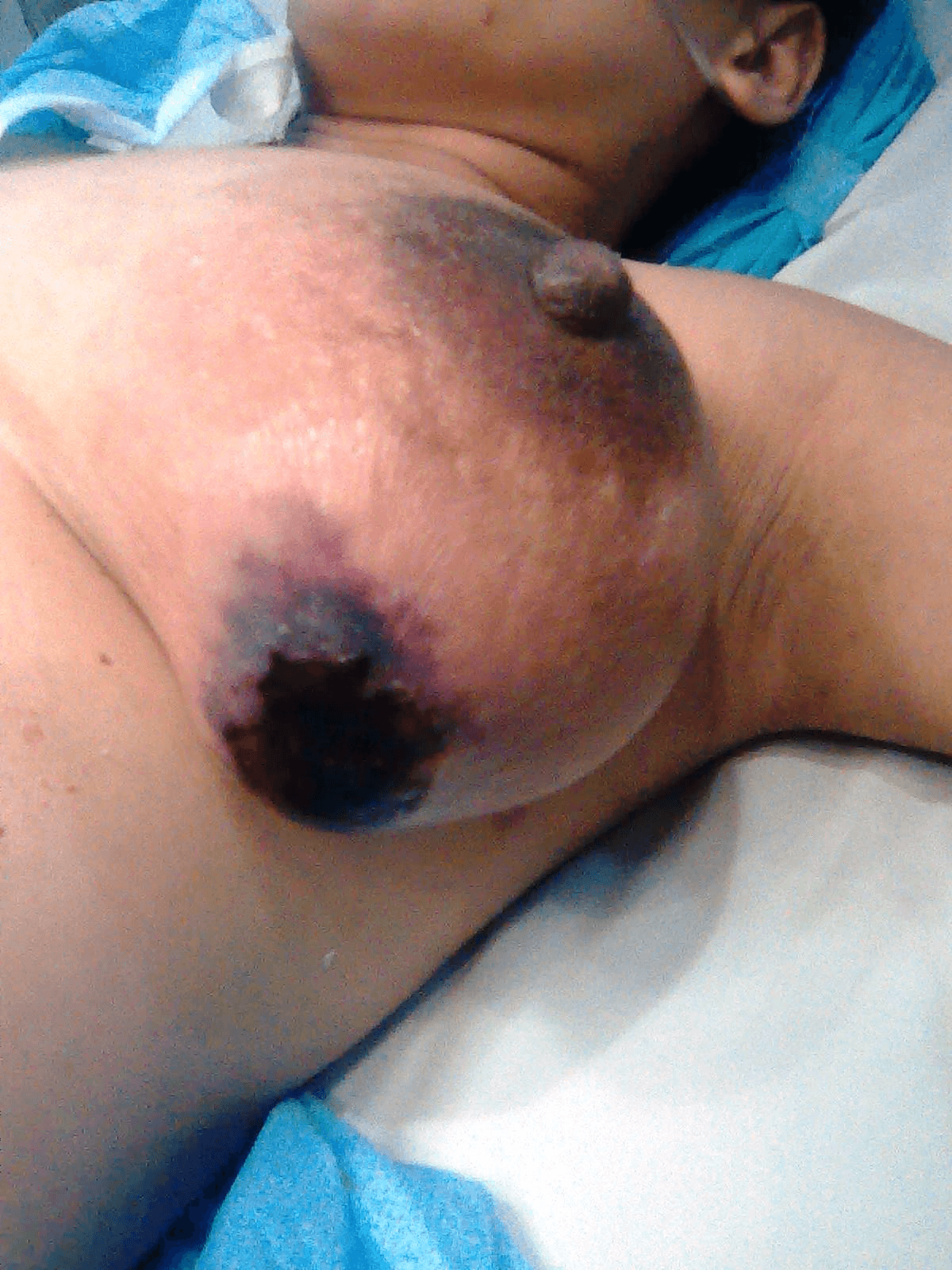 Incision et drainage d'un abces dentaire - procedure chirurgicale