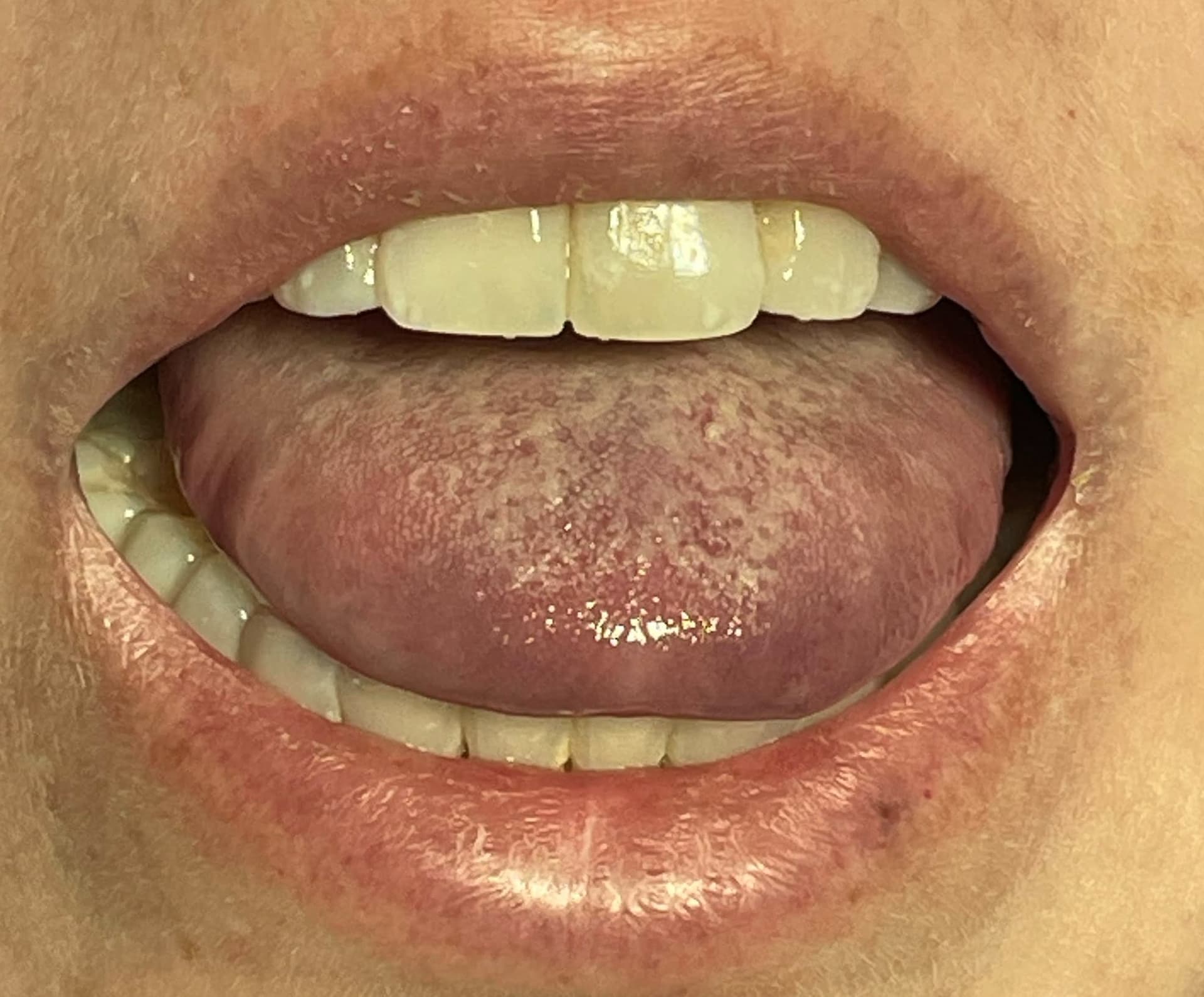 Angine de Ludwig - gonflement severe du plancher buccal et du cou, complication grave d'un abces dentaire