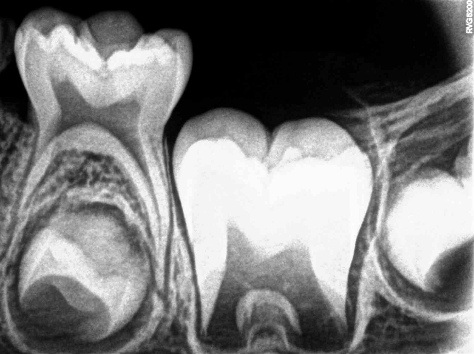 Radiographie dentaire montrant une fracture et les structures internes de la dent