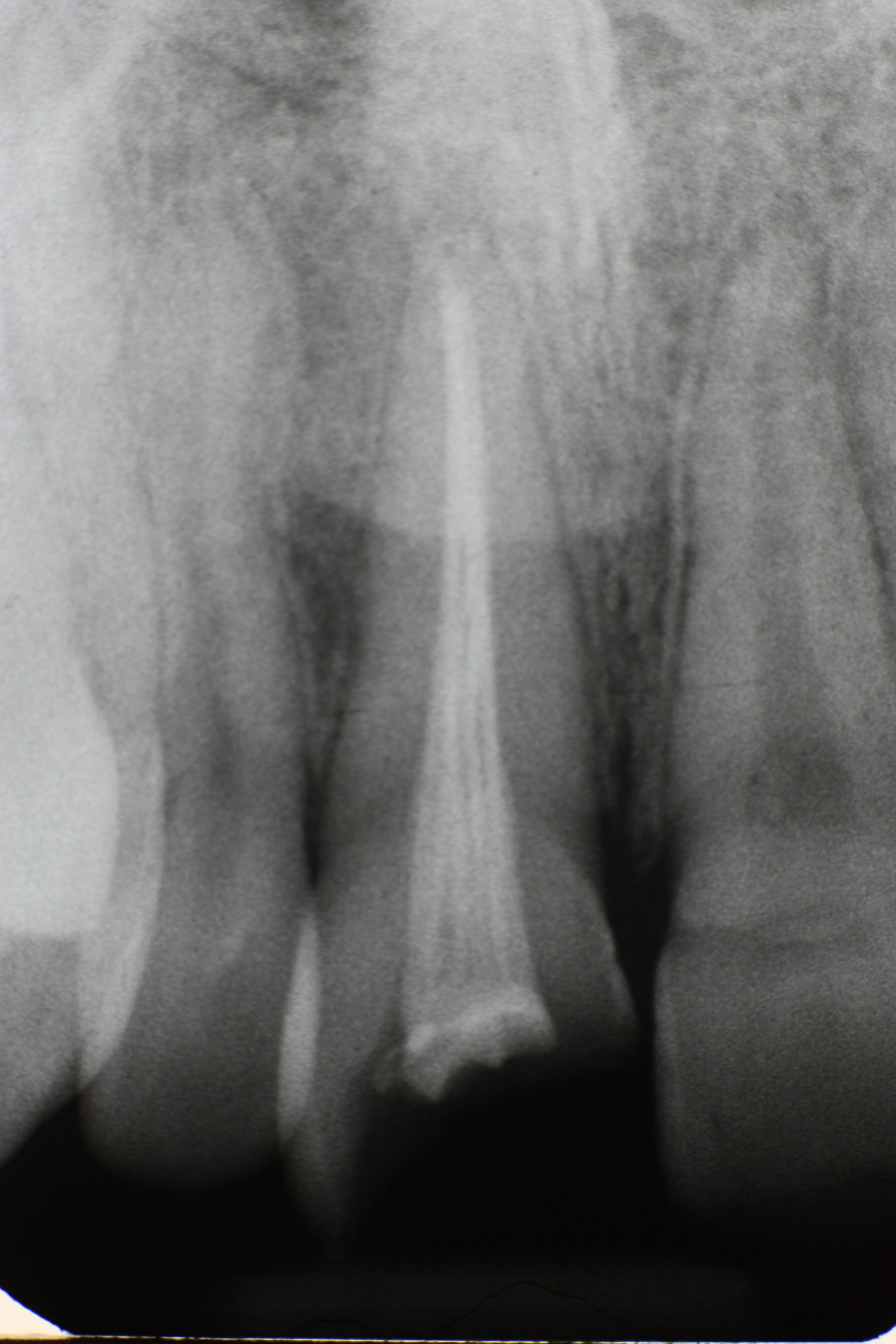 Traumatisme sur une incisive superieure - etapes de reparation par le dentiste