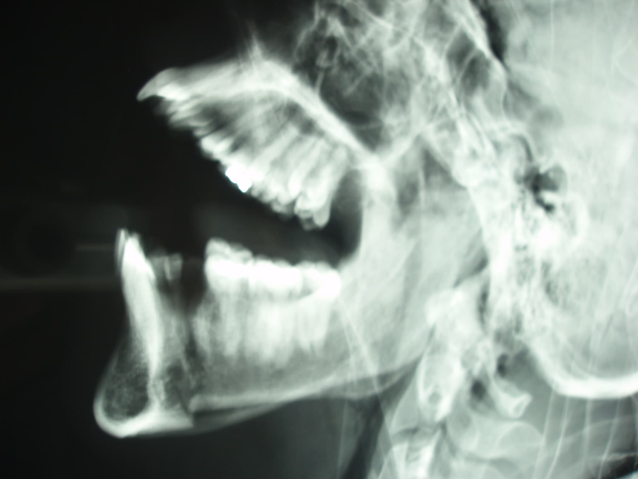 Radiographie d'une fracture mandibulaire - traumatisme facial grave