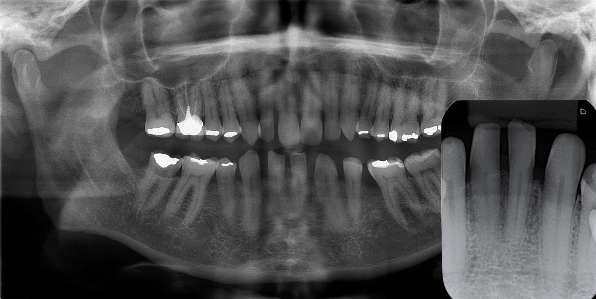 Radiographie periapicale montrant une lesion au bout de la racine apres un traumatisme