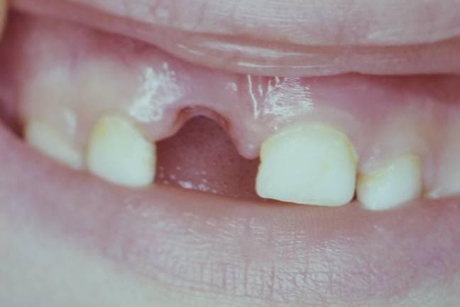 Dent expulsee (avulsion dentaire) - la dent est completement sortie de l'alveole
