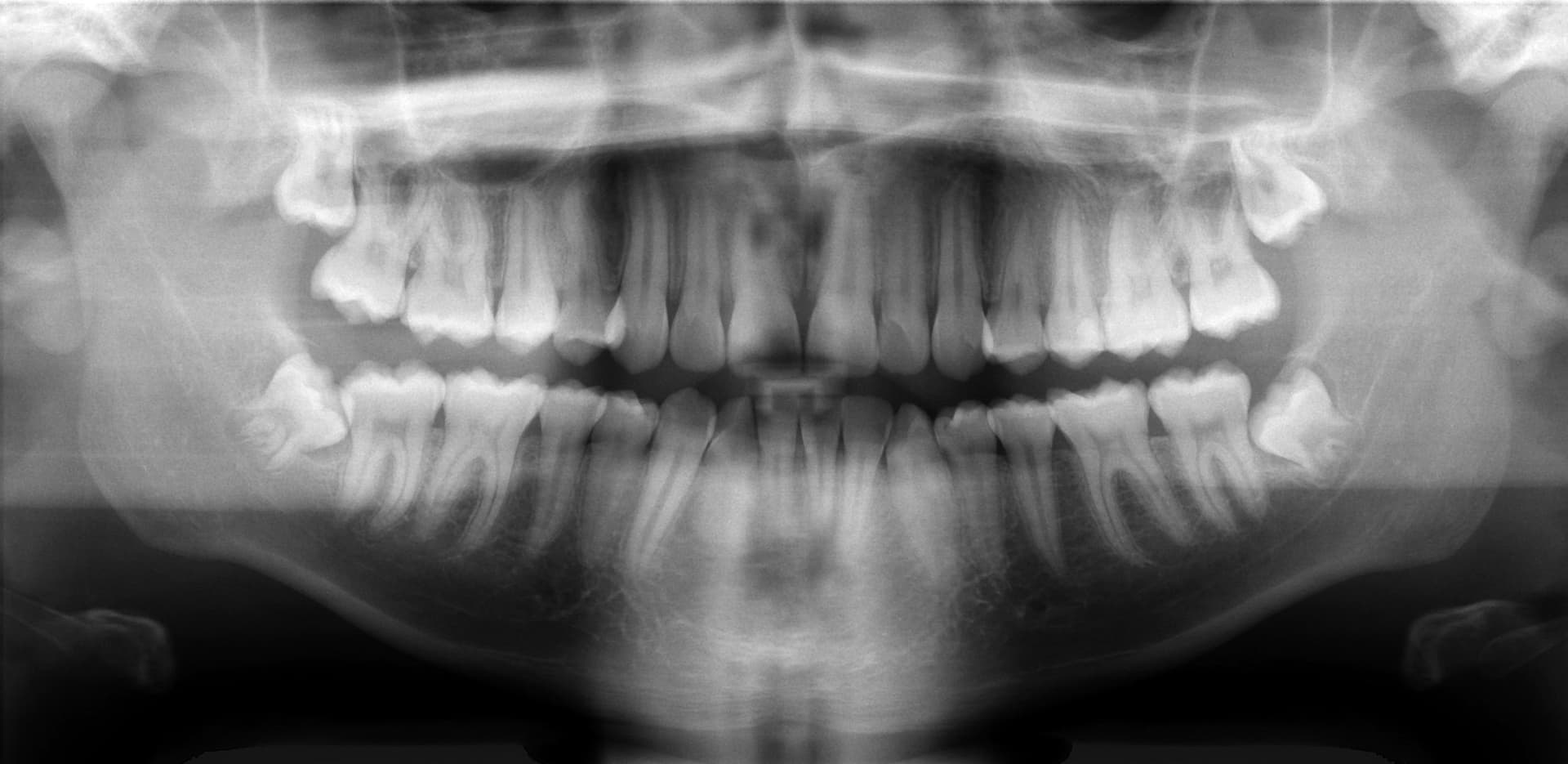 Radiographie dentaire prise lors d'une consultation d'urgence