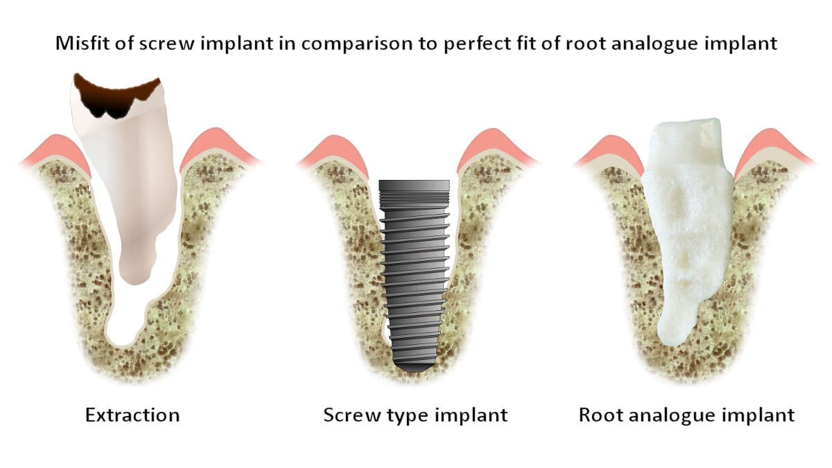 Illustration d'un implant dentaire et de sa structure