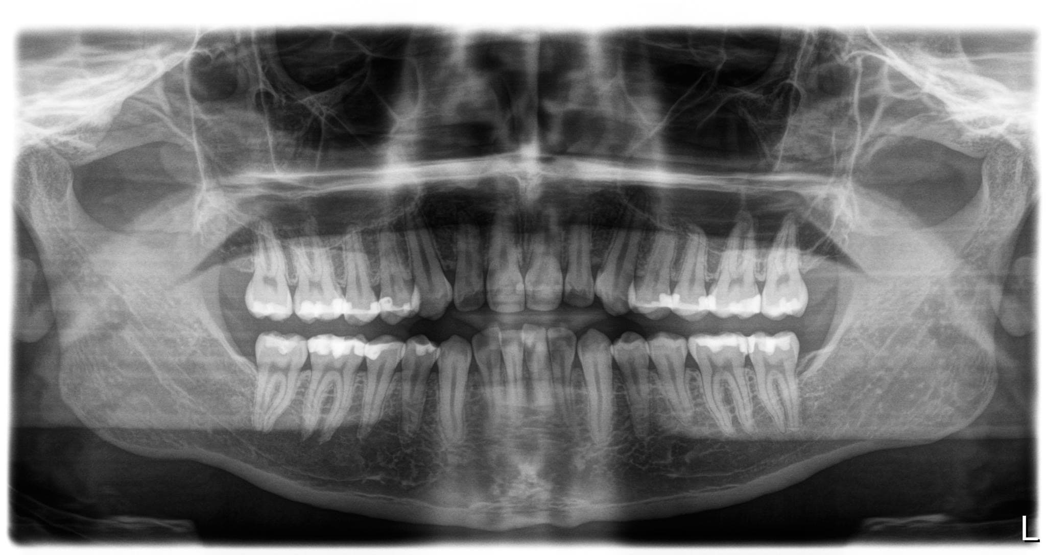 Radiographie dentaire montrant les differentes structures d'une dent