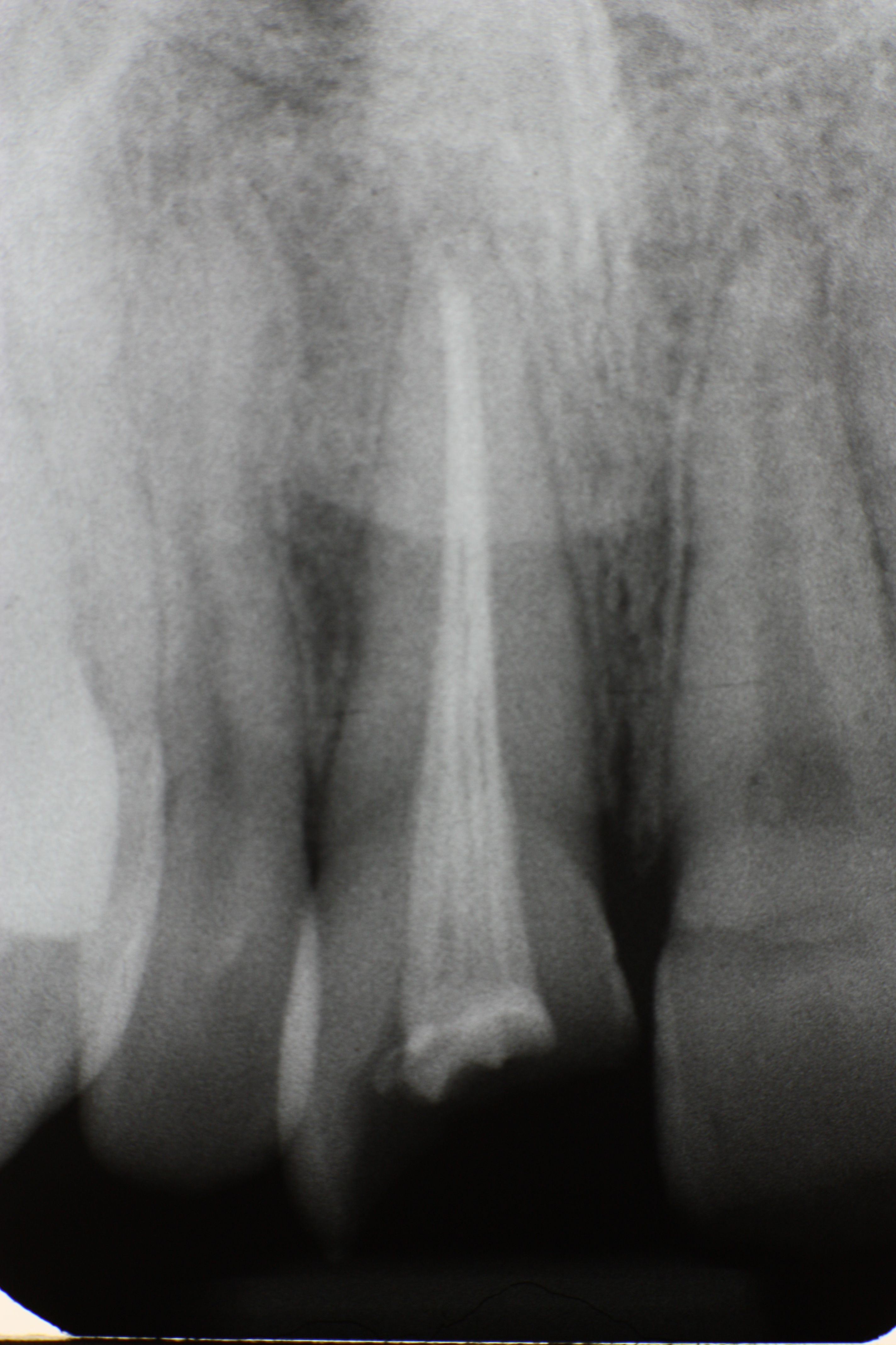 Traumatisme sur une incisive superieure - etapes de reparation par le dentiste