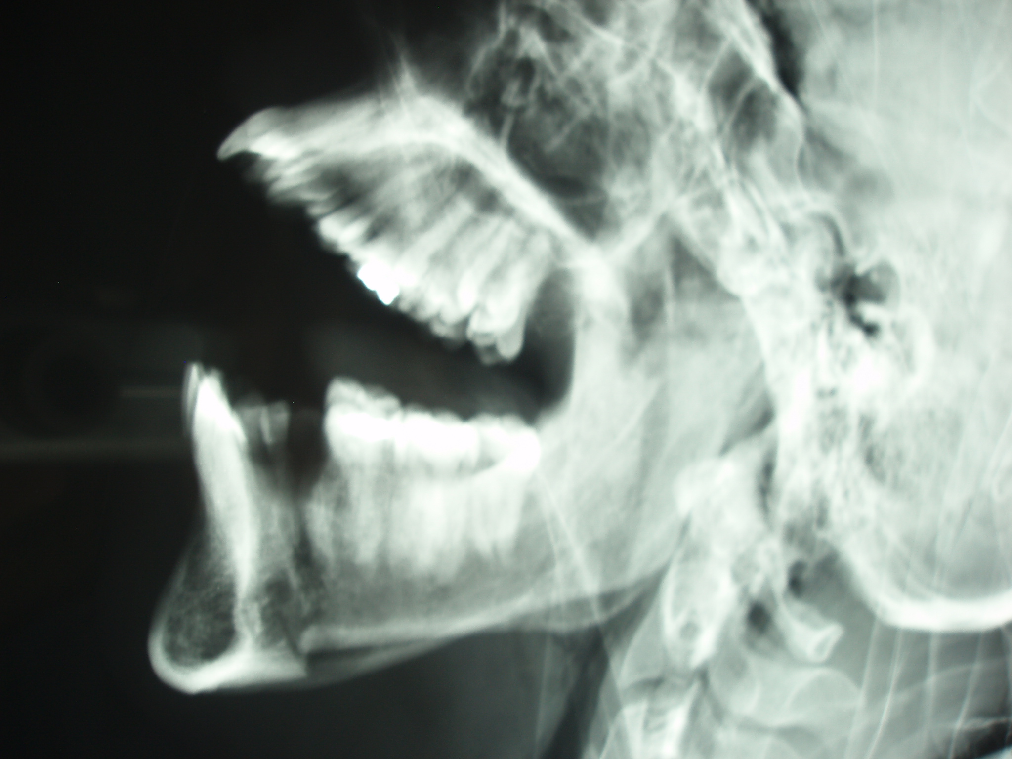 Radiographie d'une fracture mandibulaire - traumatisme facial grave