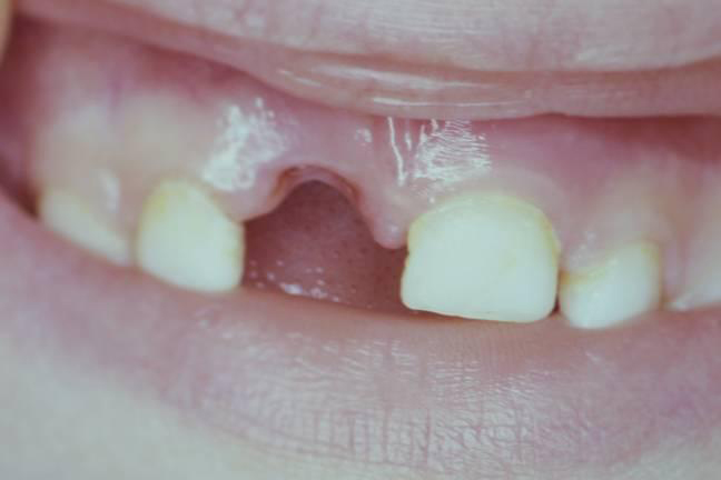 Dent expulsee (avulsion dentaire) - la dent est completement sortie de l'alveole