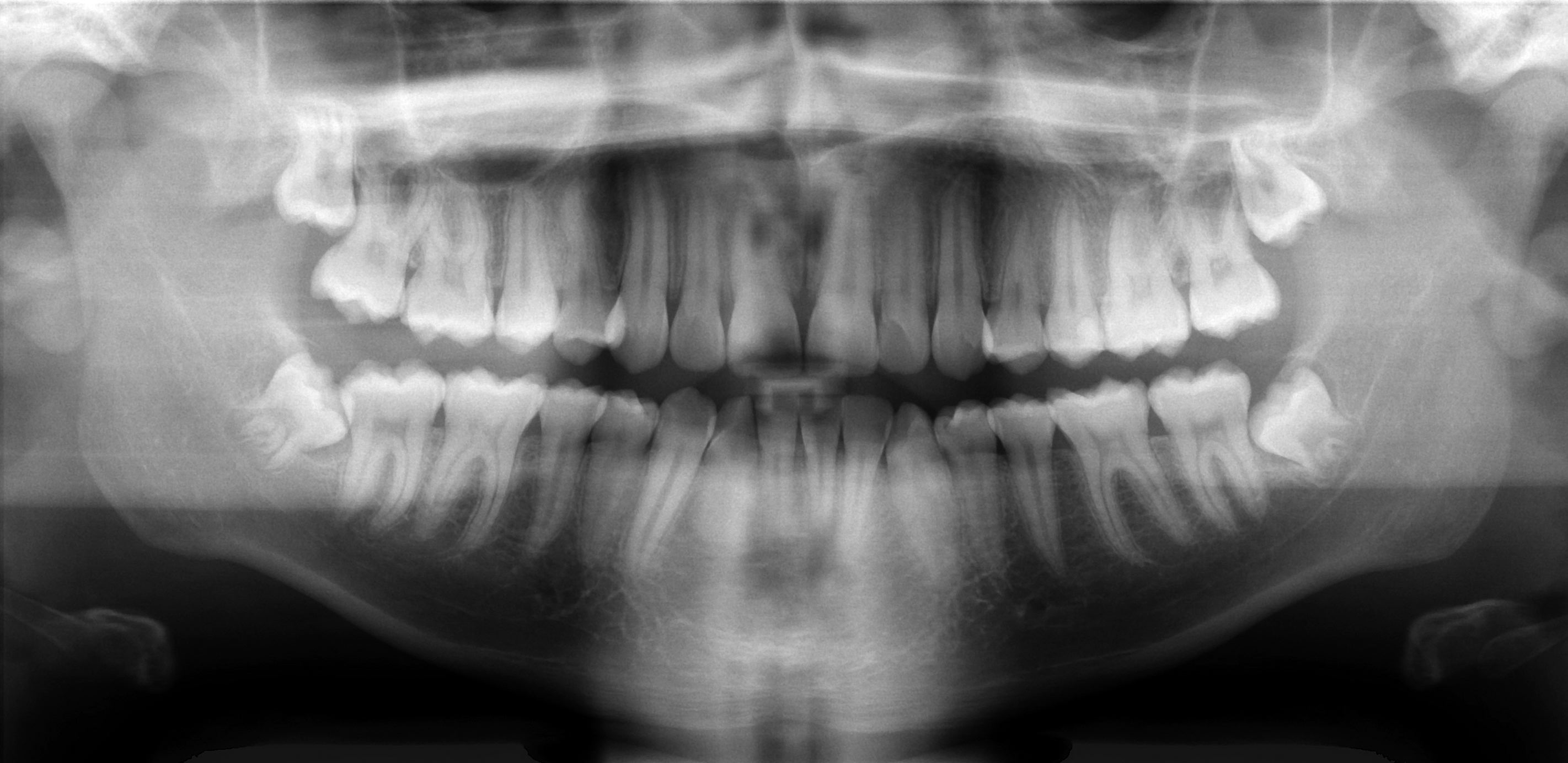 Radiographie dentaire prise lors d'une consultation d'urgence